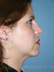 After rhinoplasty right side view female patient case 5091