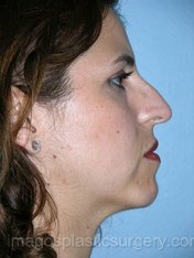 Before rhinoplasty right side view female patient case 5091