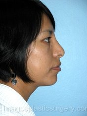 After rhinoplasty right side view female patient case 5094