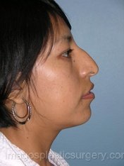 Before rhinoplasty right side view female patient case 5094