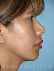 After rhinoplasty right side view female patient case 5097