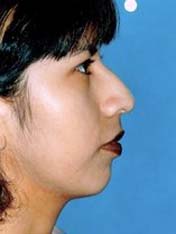 Before rhinoplasty right side view female patient case 5097