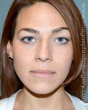 Before rhinoplasty front view female patient case 5100