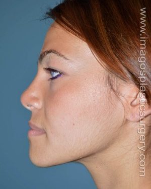 Before rhinoplasty left side view female patient case 5100