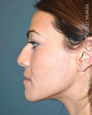 Before rhinoplasty left side view female patient case 5100