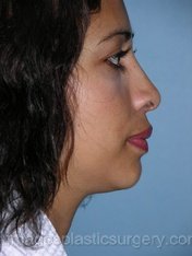 After rhinoplasty right side view female patient case 5105