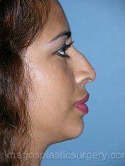 Before rhinoplasty right side view female patient case 5105