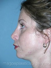 Before rhinoplasty left side view female patient case 5108