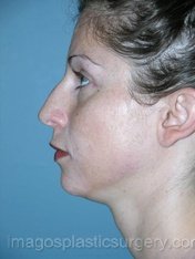 Before rhinoplasty left side view female patient case 5108