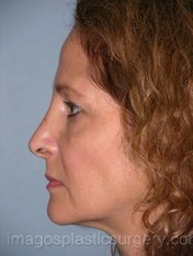 After rhinoplasty left side view female patient case 5114