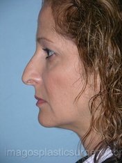 Before rhinoplasty left side view female patient case 5114