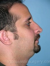 Before rhinoplasty right side view male patient case 5117