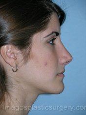 After rhinoplasty right side view female patient case 5124