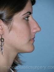 Before rhinoplasty right side view female patient case 5124