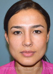 After rhinoplasty front view female patient case 5127