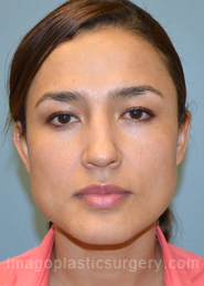 Before rhinoplasty front view female patient case 5127