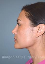 After rhinoplasty left side view female patient case 5127