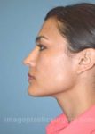 Before rhinoplasty left side view female patient case 5127