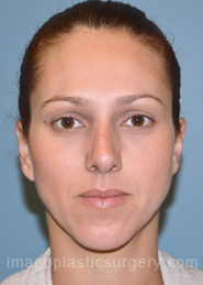 After rhinoplasty front view female patient case 5134