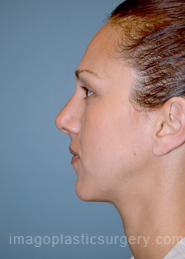 After rhinoplasty left side view female patient case 5134