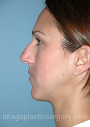 Before rhinoplasty left side view female patient case 5134