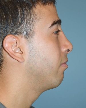 After rhinoplasty right side view male patient case 5139