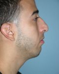 Before rhinoplasty right side view male patient case 5139