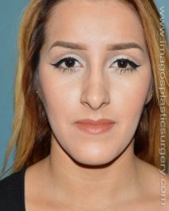 Before rhinoplasty front view female patient case 5150