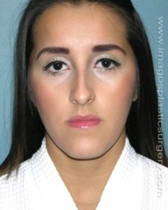 After rhinoplasty front view female patient case 5150