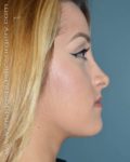 After rhinoplasty right side view female patient case 5150