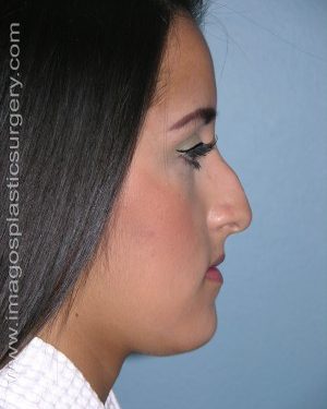 Before rhinoplasty right side view female patient case 5150