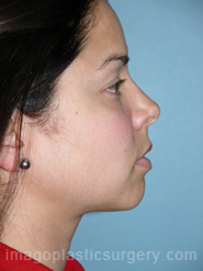 After rhinoplasty right side view female patient case 5155