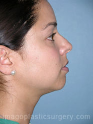 Before rhinoplasty right side view female patient case 5155