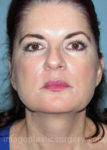 Before rhinoplasty front view female patient case 5164