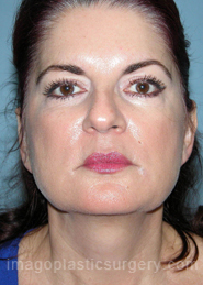 Before rhinoplasty front view female patient case 5164