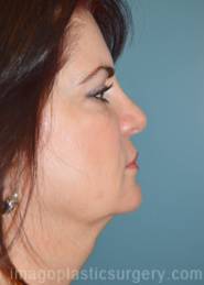 After rhinoplasty right side view female patient case 5164