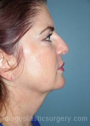 Before rhinoplasty right side view female patient case 5164