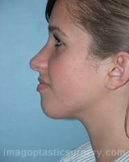 After rhinoplasty left side view female patient case 5171