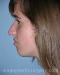 Before rhinoplasty left side view female patient case 5171