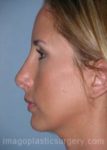 After rhinoplasty left side view female patient case 5179