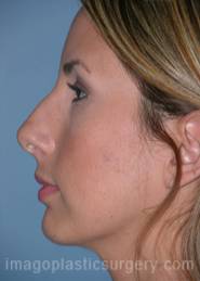 Before rhinoplasty left side view female patient case 5179