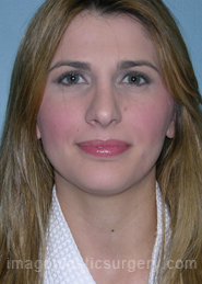After rhinoplasty front view female patient case 5187