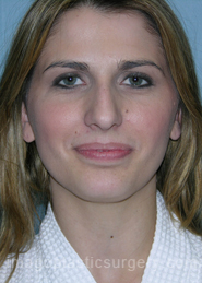 Before rhinoplasty front view female patient case 5187