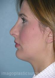 After rhinoplasty left side view female patient case 5187