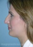 Before rhinoplasty left side view female patient case 5187