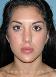 Before rhinoplasty front view female patient case 5194