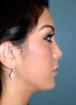 After rhinoplasty right side view female patient case 5194
