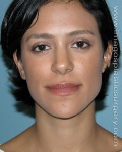 After rhinoplasty front view female patient case 5202