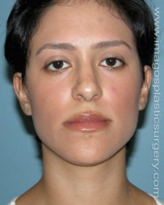 Before rhinoplasty front view female patient case 5202