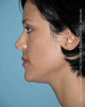 After rhinoplasty left side view female patient case 5202